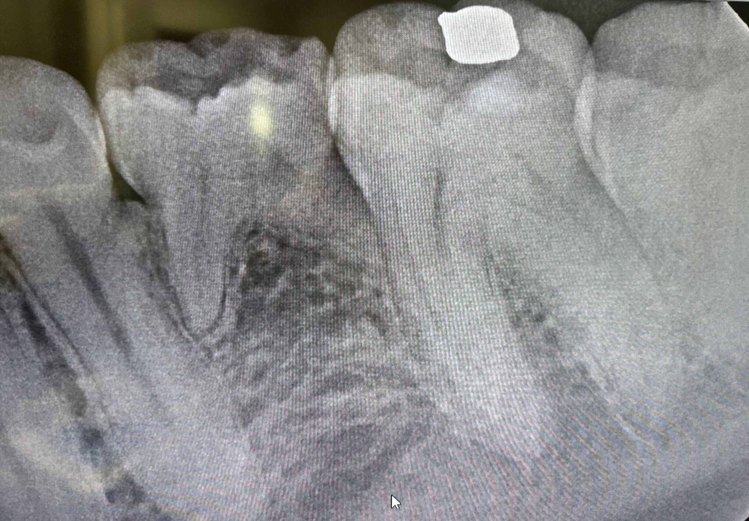 Detailed dental X-ray image revealing tooth structure, fillings, and areas affected by decay for accurate diagnosis. - Dental X-Rays