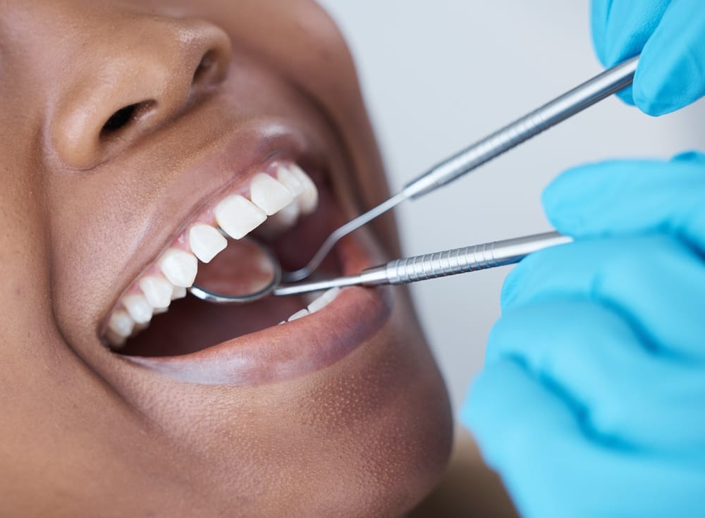 Close-up dental examination showing clean white teeth - Cosmetic Dentistry A detailed view of a dental check-up as a dentist uses stainless steel tools to examine a patient’s clean, well-aligned teeth - Cosmetic Dentistry.
