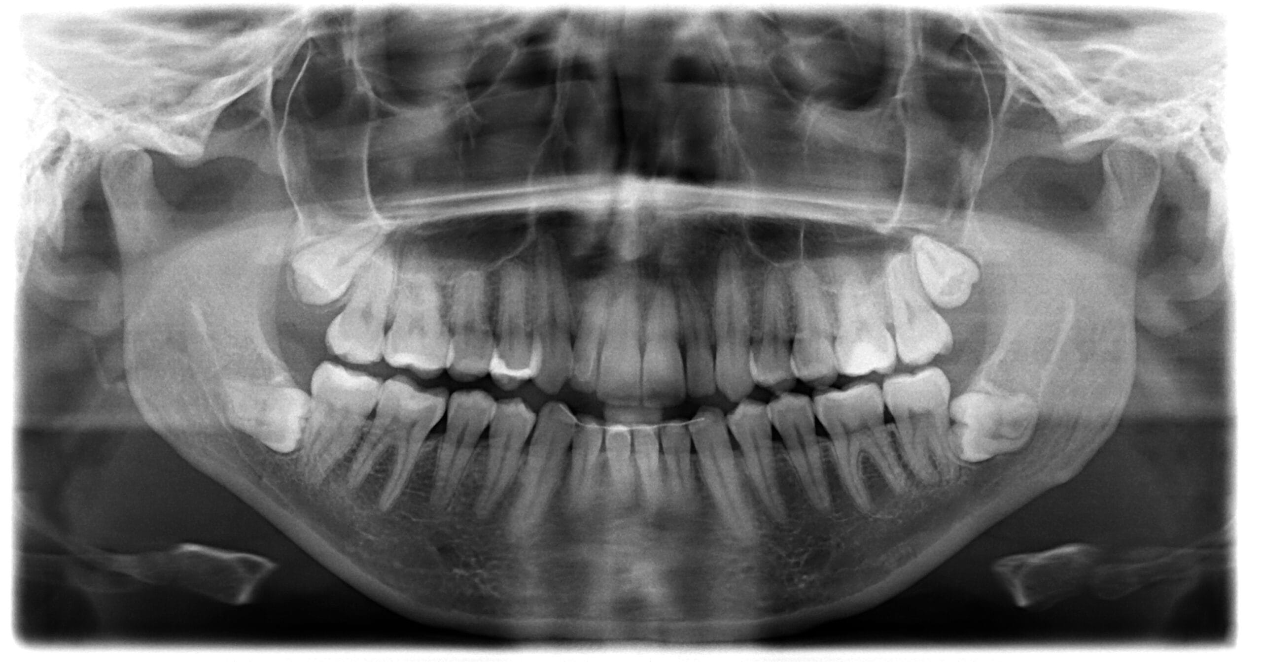High-resolution panoramic X-ray showing complete adult dentition, jaw structure, and oral health details. - Dental X-Rays